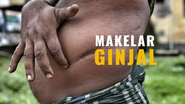 Seorang korban perdagangan organ ilegal, menunjukkan bekas luka dari operasi penyingkiran ginjal ilegal. (Foto: AFP PHOTO / Suvra Kanti Das)