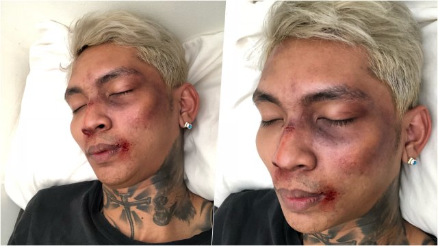 Young Lex menjadi korban pemukulan, Kamis (9/8). (Foto: Instagram @young_lex18)