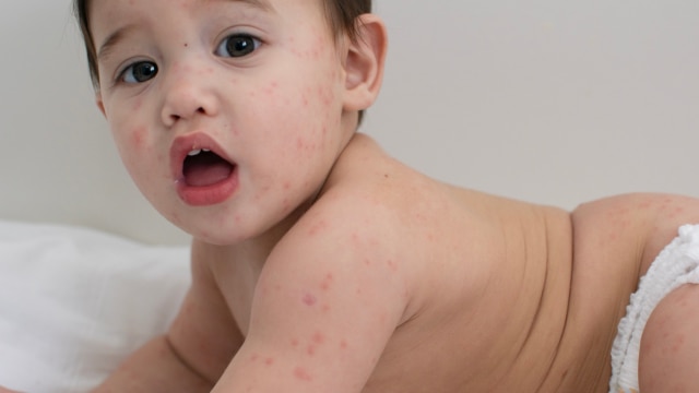 Ilustrasi cacar air pada bayi Foto: Shutterstock