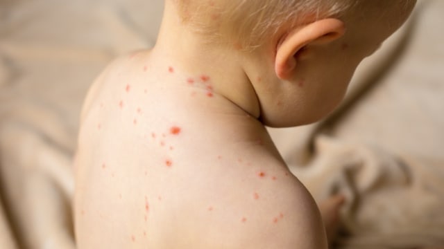 Ilustrasi cacar air pada anak. Foto: Shutterstock