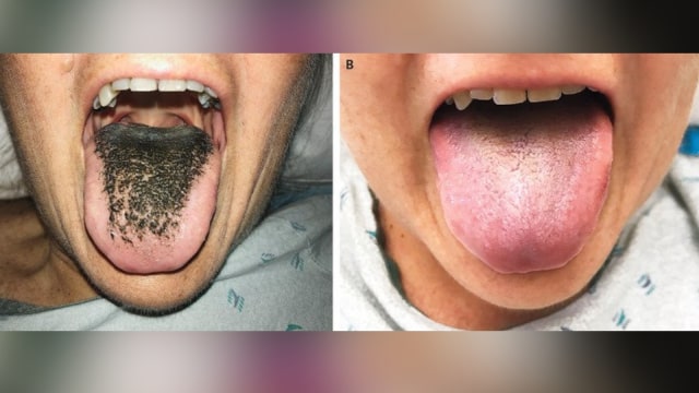 Lidah si perempuan saat ditumbuhi 'rambut' dan saat sudah kembali normal. (Foto: The New England Journal of Medicine)