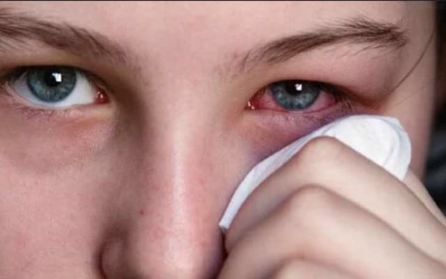 Bahaya Mengucek Mata Dengan Tangan