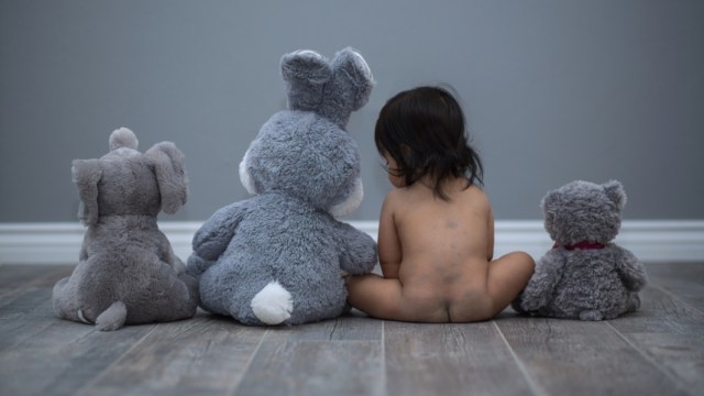 Ilustrasi bayi dengan bercak berwarna biru di pantat (Foto: Shutterstock)