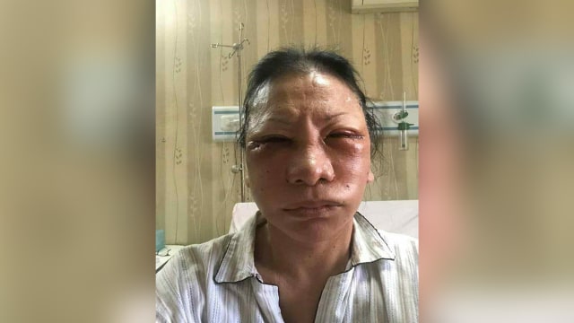 Ratna Sarumpaet babak belur. (Foto: Dok. Istimewa)