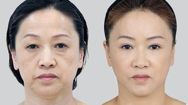 Hasil operasi facelift (Foto: dok. View Plastic Surgery)