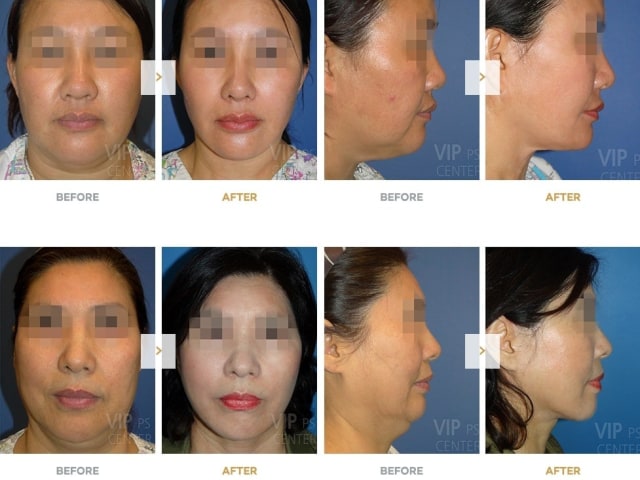Hasil operasi facelift membuat wajah lebih kencang (Foto: dok. VIP International Plastic Surgery Center)