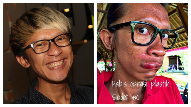 Aming posting foto babak belur (Foto: Muandy/kumparan, IG @amingisback)