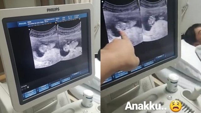 Raditya Dika dengar detak jatung calon buah hatinya untuk pertama kali. (Foto: Instagram @raditya_dika)