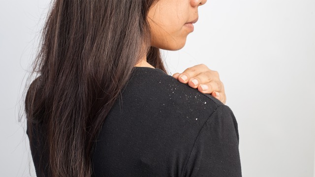 Ilustrasi Rambut Ketombe Foto: Shutterstock