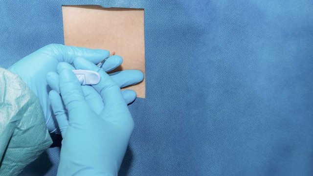 Untung Rugi Pakai Epidural Selama Persalinan