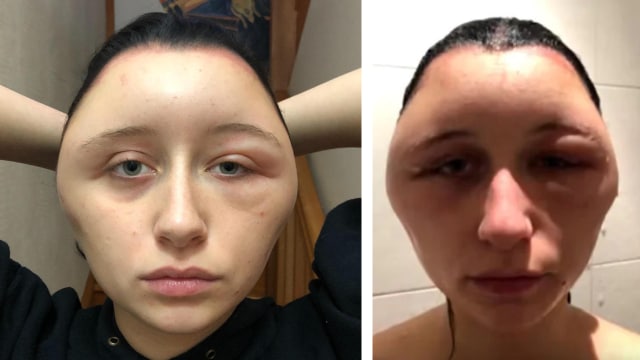 Kepala Estelle membengkak akibat reaksi alergi saat memakai pewarna rambut. (Foto: Le Parisien)