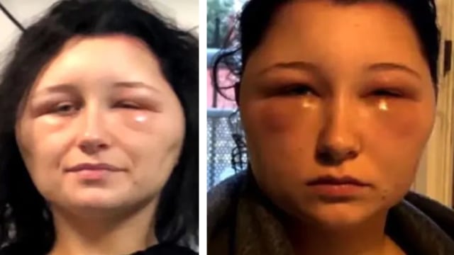 Kepala Estelle membengkak akibat reaksi alergi saat memakai pewarna rambut. (Foto: Le Parisien)