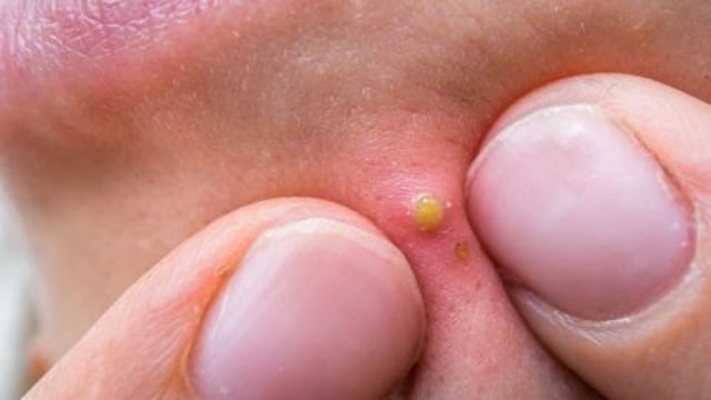 Pencet Bisul di Hidung, Bocah di Sulteng Meninggal Dunia (2)