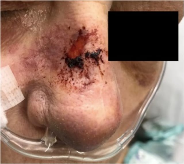 Kulit kemerahan dan luka di sekitar hidung pasien. (Foto: International Journal of Infectious Diseases)
