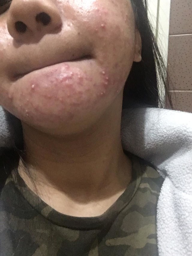 Kulit Irish rusak akibat tergiur endorse kosmetik (Foto: dok pribadi)