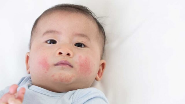 Cari Tahu Penyebab Alergi Pada Bayi Dan Cara Mengatasinya