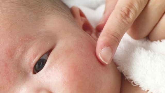Dermatitis Atopik Pada Bayi. (Foto: Facebook/@Mustela Philippines)