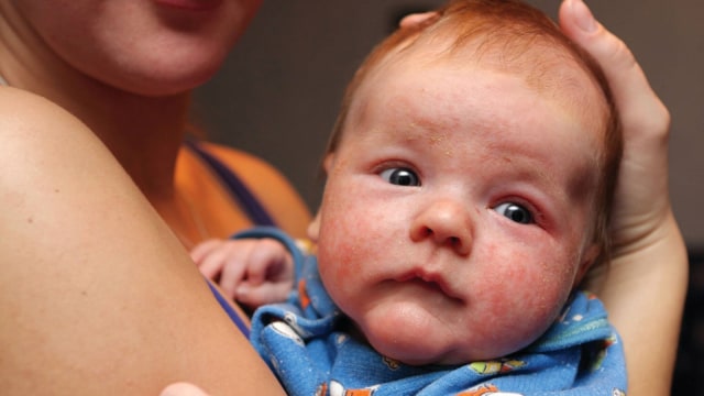 Dermatitis Atopik Pada Bayi. (Foto: Facebook/@Epi-max)