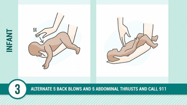 Apa Itu Manuver Heimlich? (1)