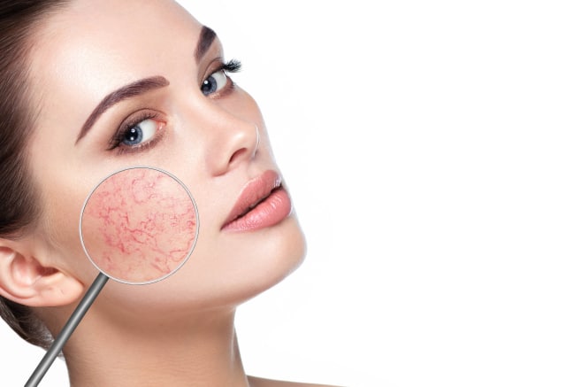 Rosacea pada kulit. (Foto: Dok. Shutterstock)