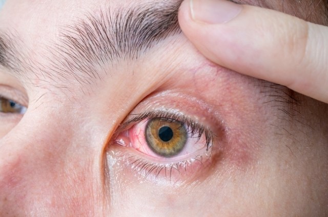 Pertama Kali Memakai Softlens? Ini Tanda Softlens Tidak Cocok! (2)