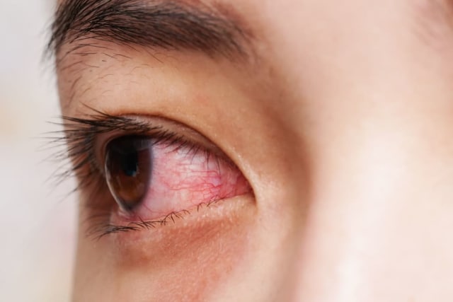 Pertama Kali Memakai Softlens? Ini Tanda Softlens Tidak Cocok! (3)
