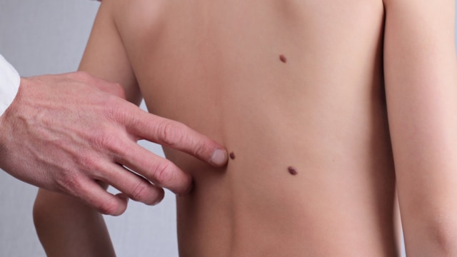 Amati kondisi tahi lalat di kulit anak dengan rumus ABCDE Foto: Shutterstock