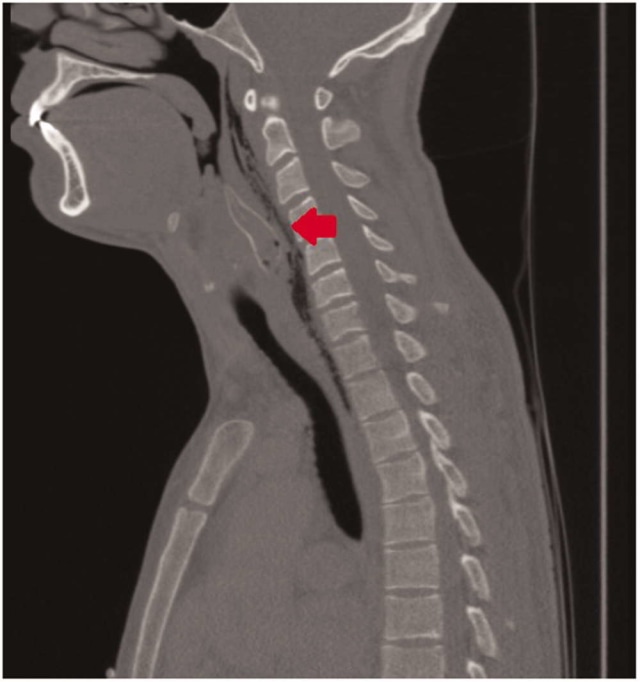 Ikan lele beracun yang tersangkut di tenggorokan di pria mabuk (Foto: Benoist et al, Erasmus University Medical Center, Rotterdam, The Netherlands)