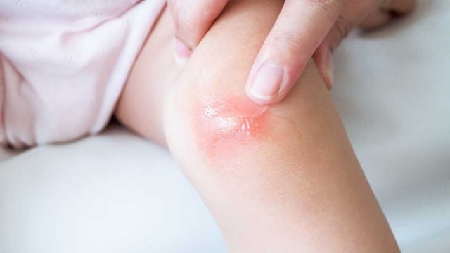 Review PURE Kids Itchy Cream