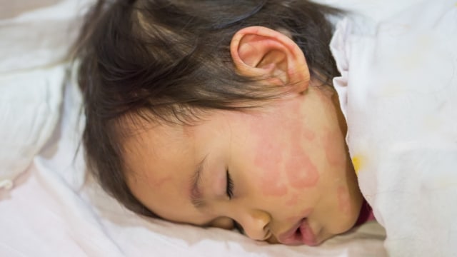 Ilustrasi anak alami biduran atau kaligata Foto: Shutterstock