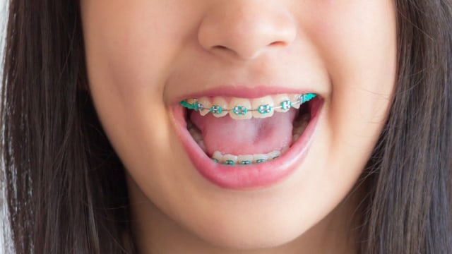 Kawat gigi Foto: Shutter Stock