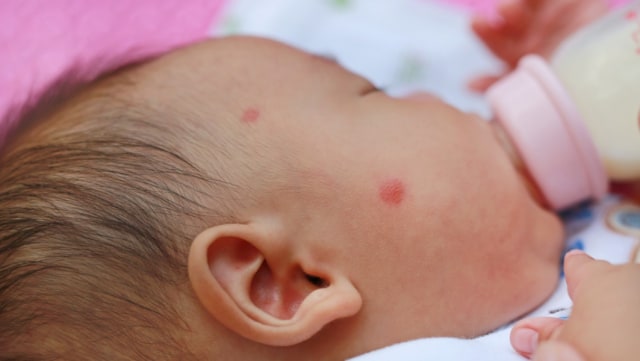 Ilustrasi bayi alergi susu sapi Foto: Shutterstock