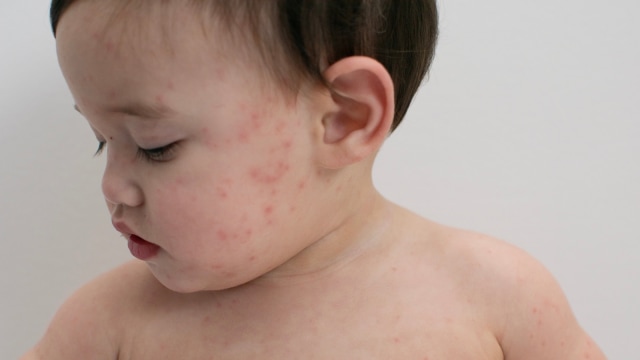 Ilustrasi anak campak. Foto: Shutter Stock