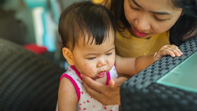 Ilustrasi anak campak. Foto: Shutter Stock