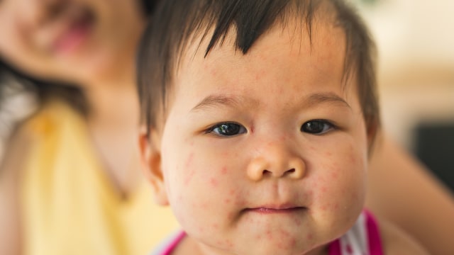 Ilustrasi anak campak. Foto: Shutter Stock