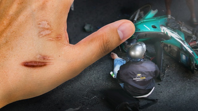 Konten spesial: Sengsara Tanpa Sarung Tangan Motor, luka scar akibat goresan dengan aspal Foto: Shutter Stock dan Putri Sarah/kumparan