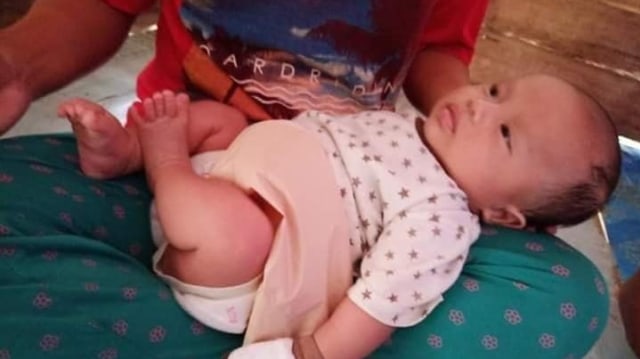 Muhammad Fadil (2 bulan), bayi yang lahir tanpa anus di Polewali Mandar, Sulawesi Barat.