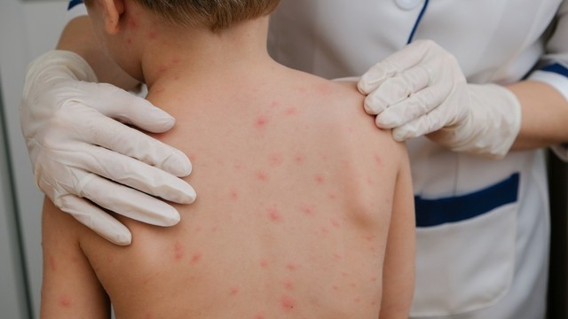 Ilustrasi cacar. Foto: Shutterstock