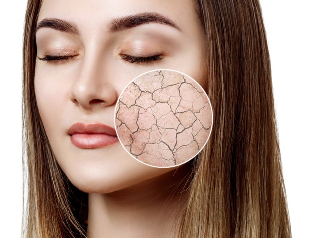 Ilustrasi kulit kering. Foto: Shutterstock