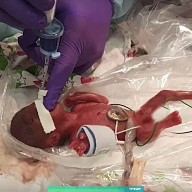 Saybie, bayi terkecil di dunia. Foto: Youtube/Sharp HealthCare