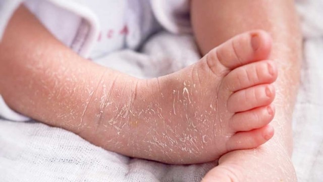 6 Cara Mengatasi Kulit Bayi yang Mengelupas
