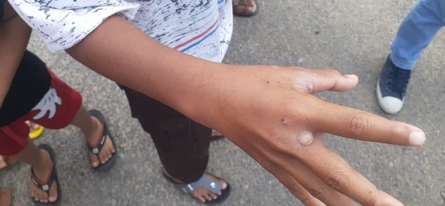 Seorang anak yang menjadi korban serangan ulat bulu, di Pangkalpinang.