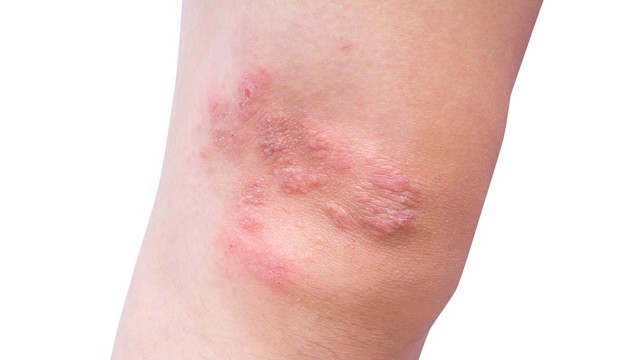 Kondisi kulit yang terkena psoriasis. Foto: Shutter Stock
