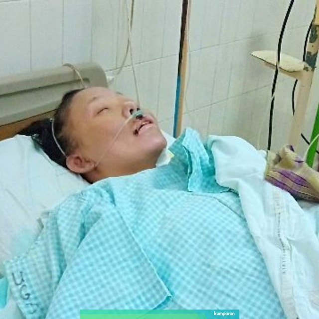 Nilan Oktavia alami luka bakar 90 persen. Foto: Dok. Doni