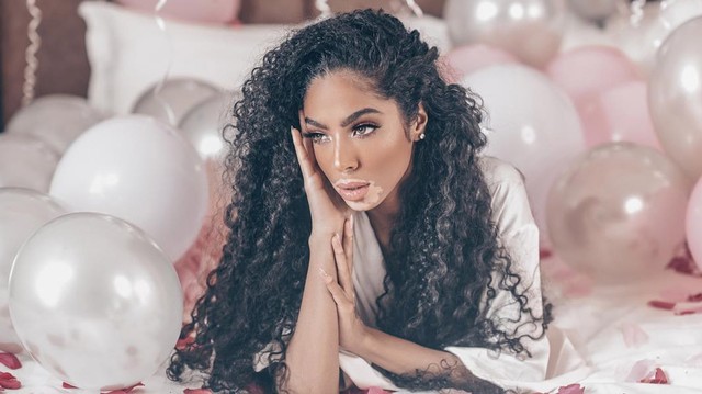 Shahad Salman, model vitiligo asal Mekkah Arab Saudi. Foto: dok. Instagram @5sunshine1