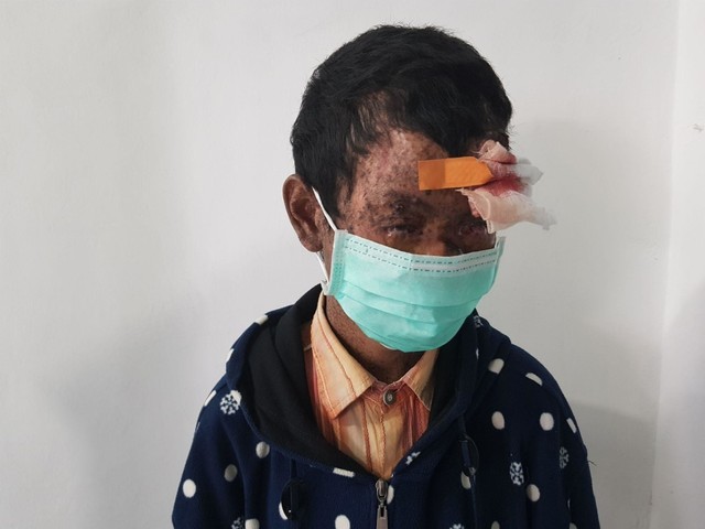 Rifky mengidap Xeroderma pigmentosum sejak duduk di bangku Taman Kanak-kanak. Foto: Windy Goestiana/Basra