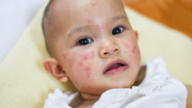 Ilustrasi bayi jerawatan Foto: Shutterstock