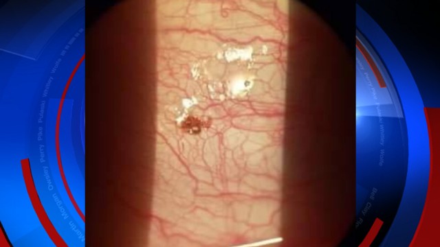 Seekor kutu di mata seorang pria. Foto: Dok. Chris Prater