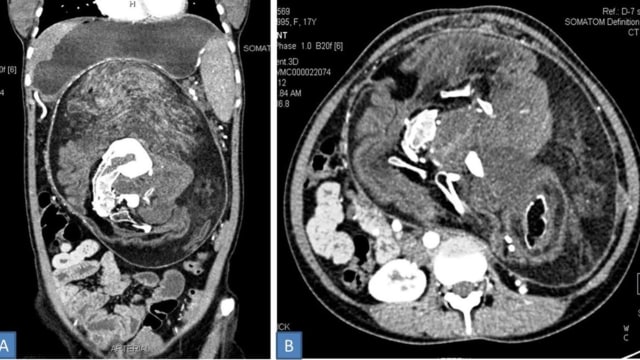 Foetus in foetu, kondisi janin diserap janin lain di awal masa kehamilan. Foto: BMJ Case Reports