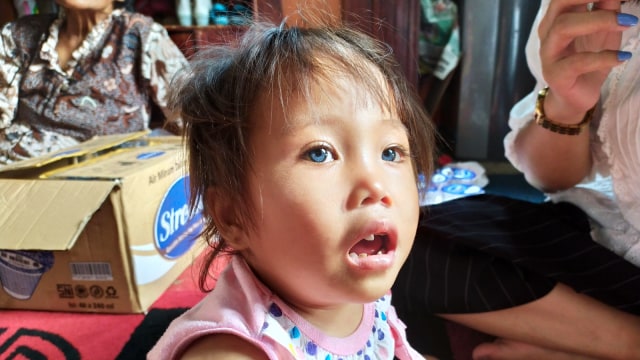 Anak perempuan berusia 2,5 tahun Amelia Anggraeni  yang punya empat warna bola mata. Foto: Rachmadi Rasyad/kumparan
